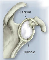 schouderimpingement