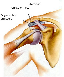 schouderimpingement